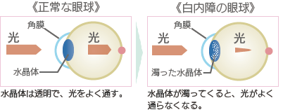 正常な眼球、白内障の眼球